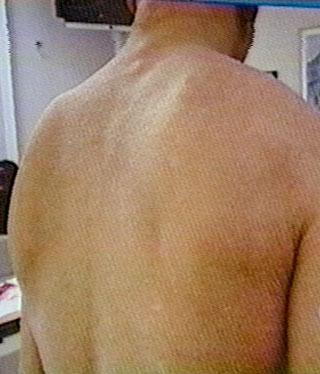 rash on back