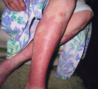 rash on legs