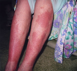 rash on legs