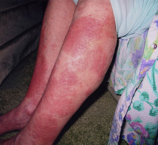 rash on legs